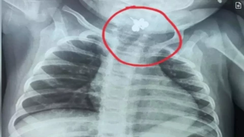 Bebé con anillo atorado en la garganta