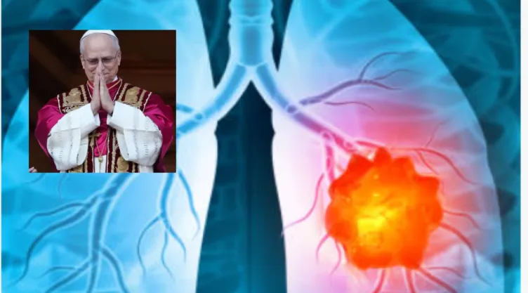 Cáncer de pulmón: causas y factores de riesgo tras el caso del papa León XIV