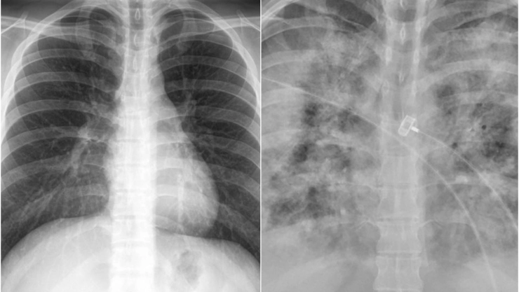 pulmones covid-19 personas no vacunadas.jpg