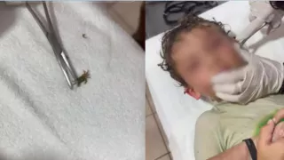 VIDEO: Captan extracción de cangrejo que entró al oído de un niño tras nadar en el mar