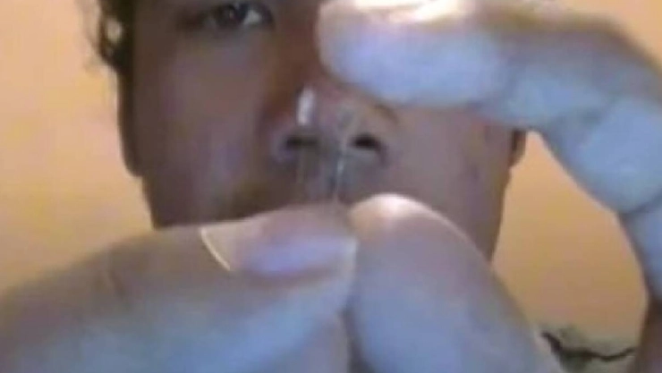 Hombre se opera la nariz el mismo