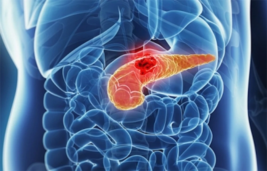 Cáncer de pácreas
