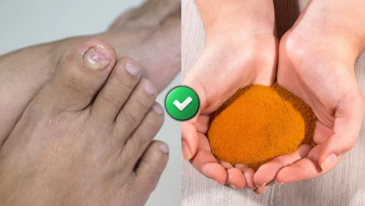 /horoscopos/como-eliminar-los-hongos-de-los-pies-este-es-el-truco-casero