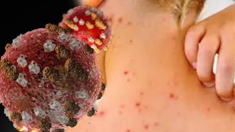 ¡Sarampión cobra vidas! Suman 31 muertes por la enfermedad en México