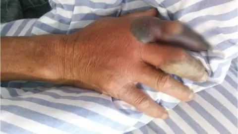 Ataque bacteria come carne.