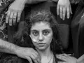 Joven armenia se recupera del Síndrome de Resignación, un síndrome disociativo que induce un estado catatónico