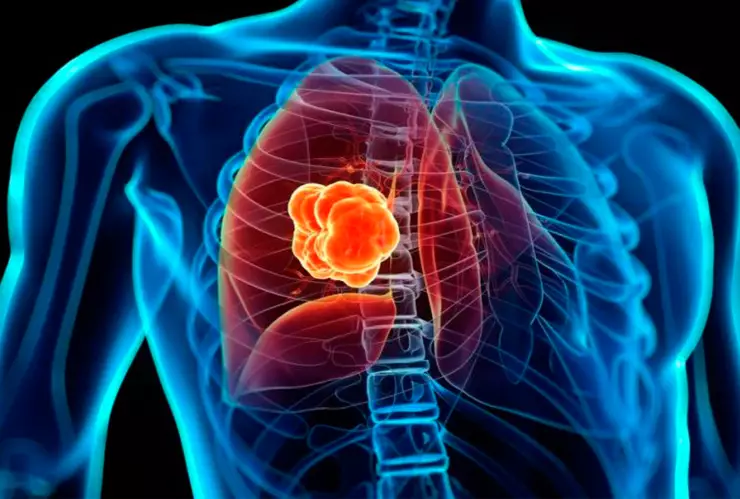 cáncer de pulmón 