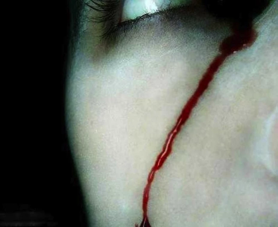 Una joven chilena llora sangre por ambos ojos, oftalmólogos investigarán su caso