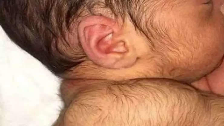 Síndrome del hombre lobo_ ¿Qué es y por qué se da en bebés_.jpg