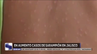 Sarampión