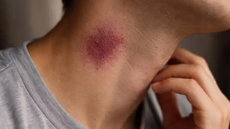 ¡Alarmante! Joven muere tras recibir un “chupetón” en el cuello, esto se sabe