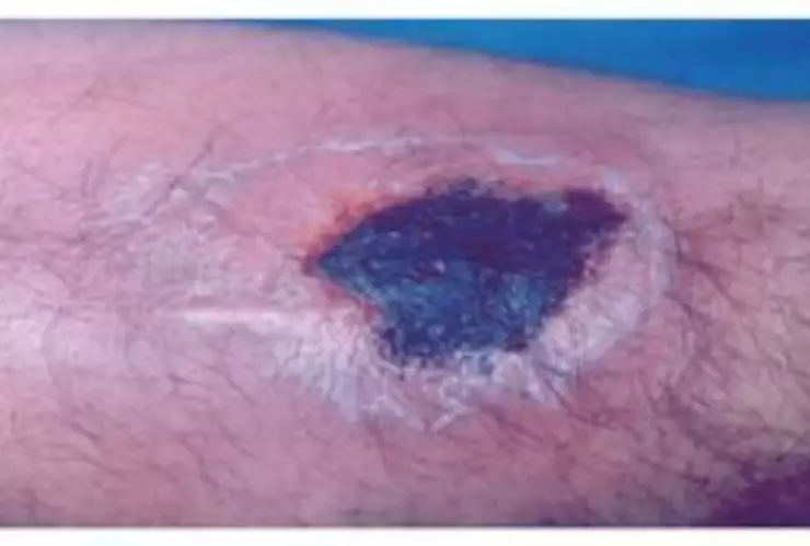 Necrosis por mordedura de araña violinista.jpg