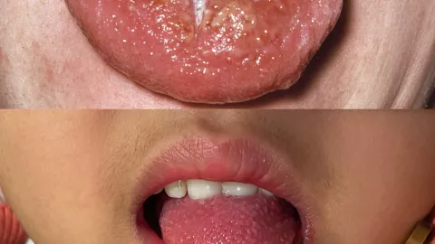 La capa blanca inicial y la posterior lengua escarlata que caracteriza a la escarlatina