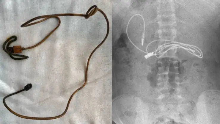Menor fue al doctor por dolor estomacal; tenía cable USB en el colon