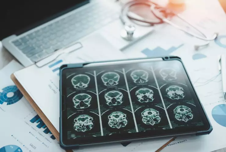 Según estudio, el ayuno intermitente podría combatir el Alzheimer