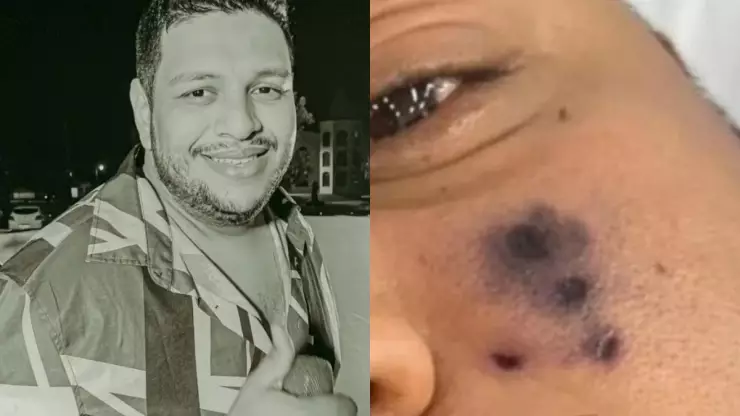 Darlyn Morais Muere famoso cantante brasileño por picadura de araña en el rostro