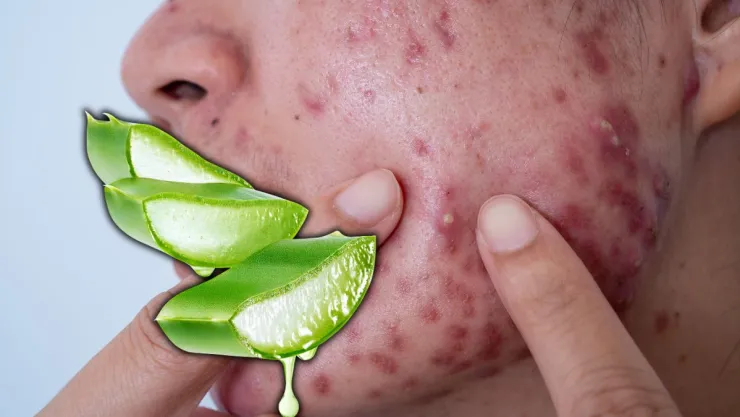 Cómo usar la sábila para eliminar el acné y rejuvenecer el rostro