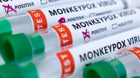 Aumentan los casos confirmados de viruela del mono en México a 386.