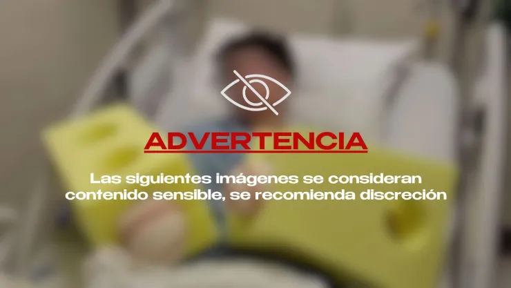 ¡IMÁGENES SENSIBLES! Joven PIERDE LAS MANOS tras fuerte accidente con fuegos artificiales