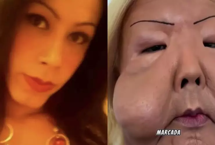 /famosos/influencer-juju-do-pix-termina-cara-desfigurada-recibir-inyecciones-clinica-ilegal-pb-notas