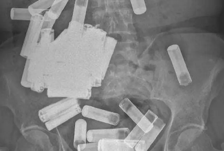 Mujer se traga 55 baterías.jpg