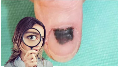 uñas melanoma como son fotos