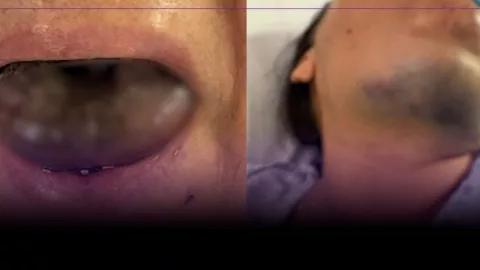 VIDEO: ¡IMÁGENES FUERTES! Hospitalizan a mujer tras amanecer con la lengua negra