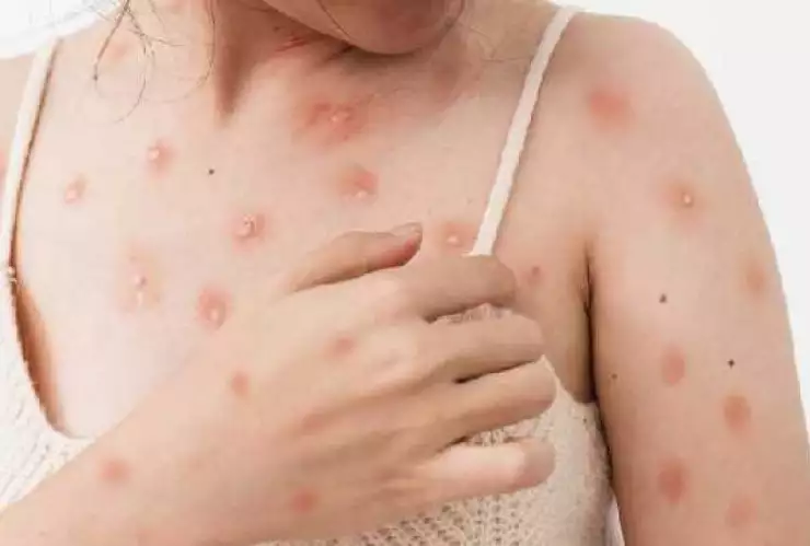 VIRUELA DEL MONO EN qUINTANA rOO