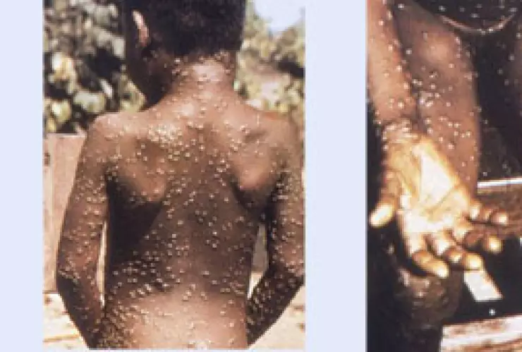 viruela del mono.jpg