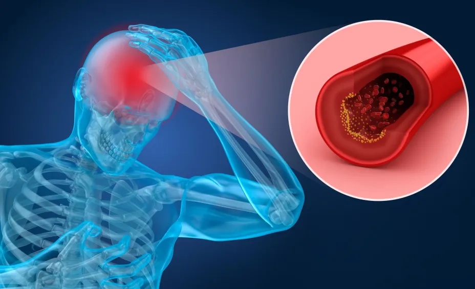 Infarto cerebro vascular -alexmit.jpg