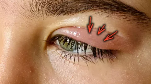 /estilo-de-vida/como-bajar-inflamacion-parpado-ingredientes-naturales