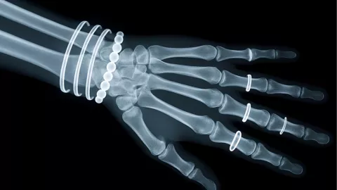 Anillo atorado: tres métodos fáciles y seguros para retirarlo sin lastimarte