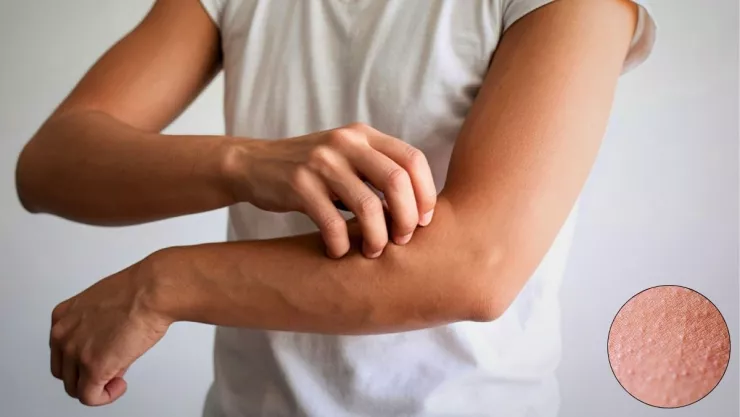 Las claves para prevenir las urticarias en la piel, según expertos.jpg