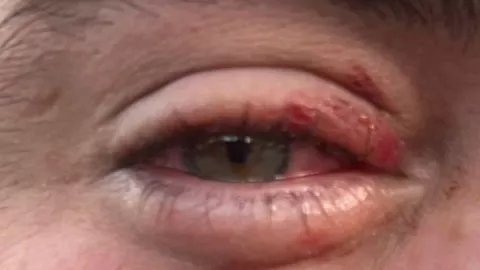 Arturo Islas Allende muestra lo que le pasó en el ojo.