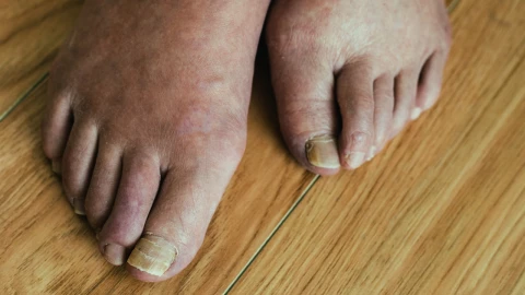 &iquest;No jugas al futbol y ten&eacute;s los pies hinchados? Cuidado, puede ser una se&ntilde;al