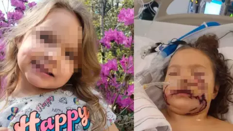 Niña no volverá a sonreír luego de que pitbull le destrozó la cara