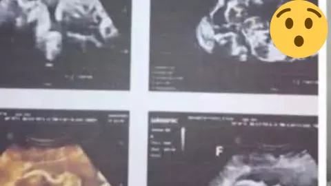 IMÁGEN IMPACTANTE: Así fue como confirmaron que la joven embarazada de quintillizos en Zacatecas resultó ser falso 