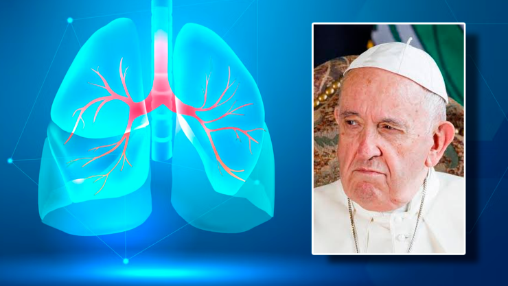 enfermedad del Papa Francisco