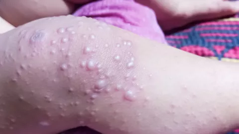 Coxsackie, ¿Qué es y cuáles son sus síntomas?