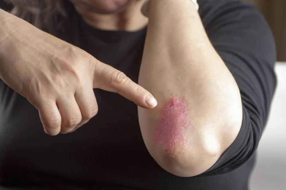 Soriasis y salud cardiovascular