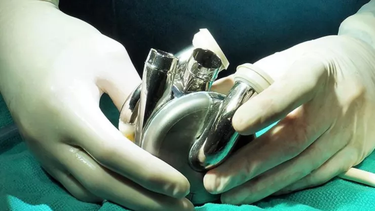 El primer paciente del mundo dado de alta del hospital y que sobrevivió 100 días con un corazón artificial
