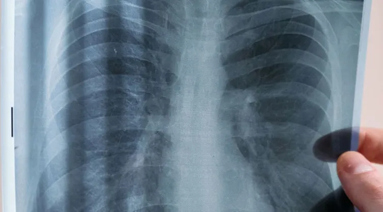 ¿Cómo se transmite la peste neumónica? Estas son las principales vías de contagio
