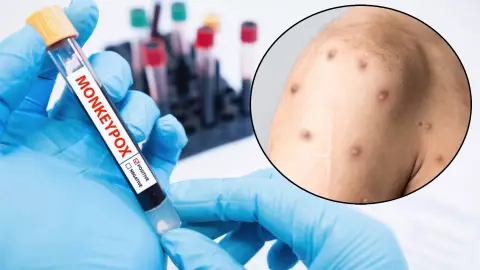 Estos son los ESTADOS que tienen más casos de viruela de mono en México