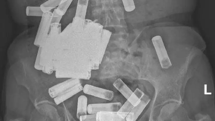 Mujer se traga 55 baterías.jpg