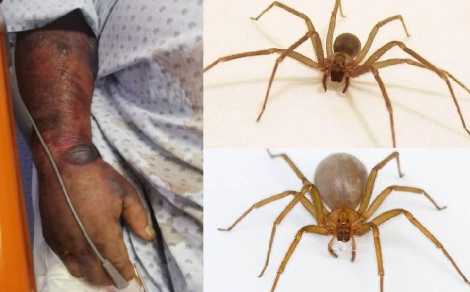 Un hombre de 50 años de edad de Salvatierra, Guanajuato, falleció luego de haber sido picado por una araña violinista.