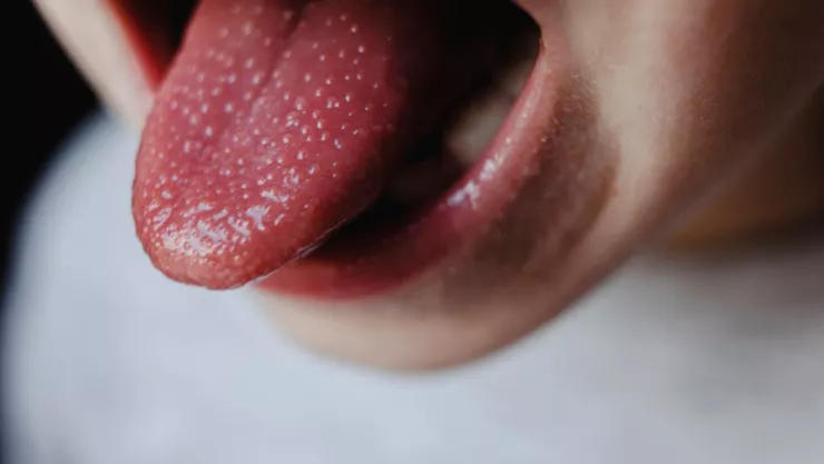 Casos de escarlatina en M&eacute;xico