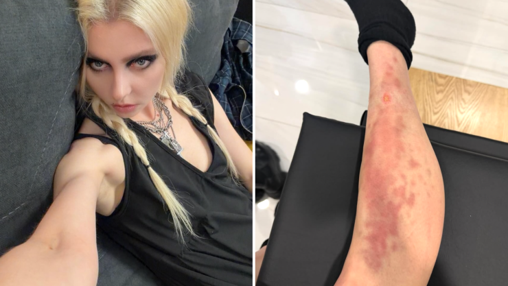 TAYLOR MOMSEN PICADURA.png