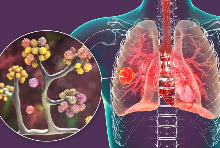 Hongo negro: Qué es, cómo se contagia y con qué se quita este padecimiento