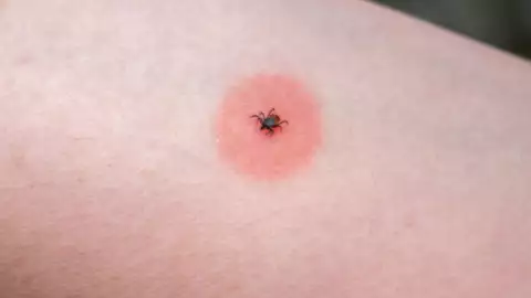 Enfermedad de chagas.