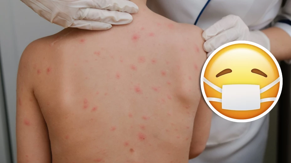 México contabiliza más de 4 mil casos de sarampión; hay 14 fallecidos.jpg